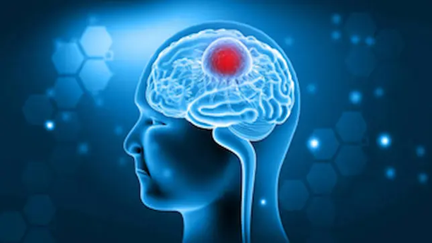 brain Tumor
