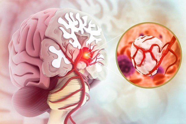 Radiofrequency lesioning