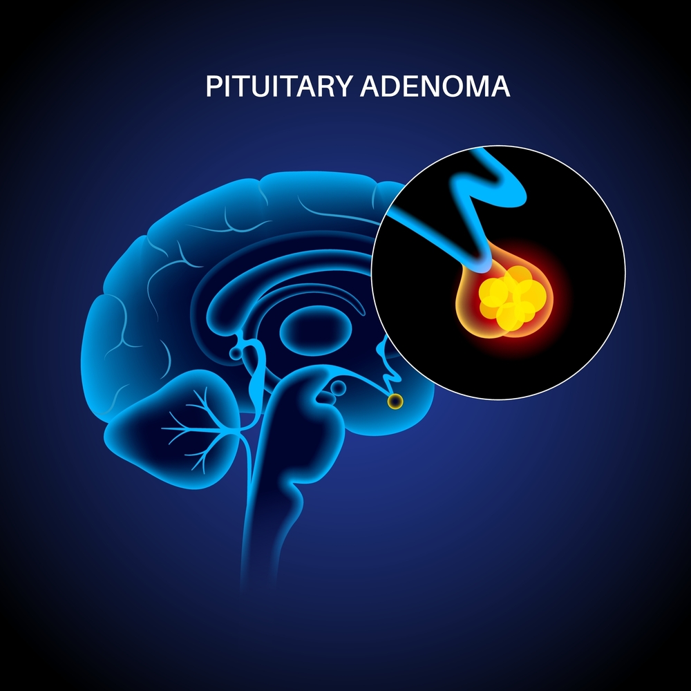 Pituitary,Adenoma,Concept.,Tumor,In,The,Human,Brain.,Disease,Or