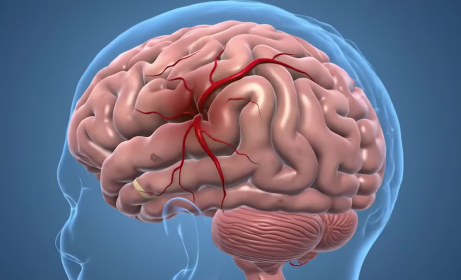 What Are the 10 Causes of a Stroke? A Neurosurgeon Explains