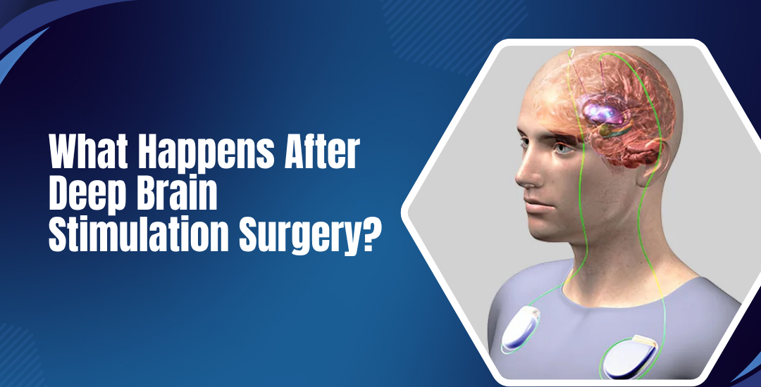 What Happens After Deep Brain Stimulation Surgery?